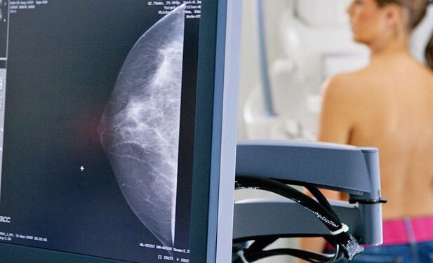 Mato Leitão: Prefeitura prepara novo mutirão de mamografias